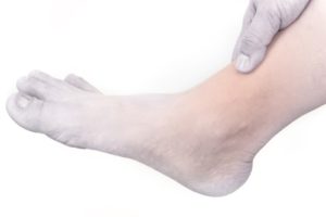 diabetic neuropathy