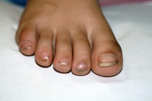 ingrown toenails