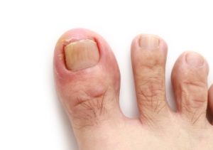 ingrown toenails