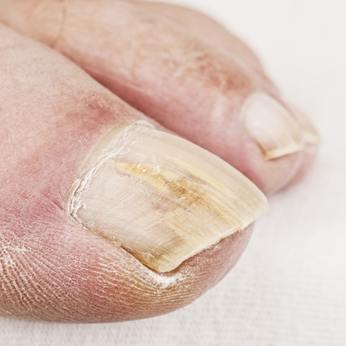 Nail Fungus - Podiatrist in Ridgefield, CT | Advanced Foot Care Center