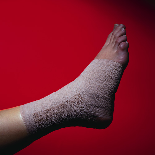 swollen foot with bandaging