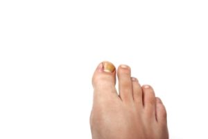 ingrown toenails